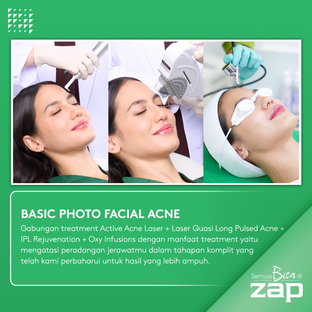 Basic Photo Facial Acne - Active Acne Laser + Laser Quasi Long Pulsed Acne + IPL Rejuvenation (125 shots) + Oxy Infusions