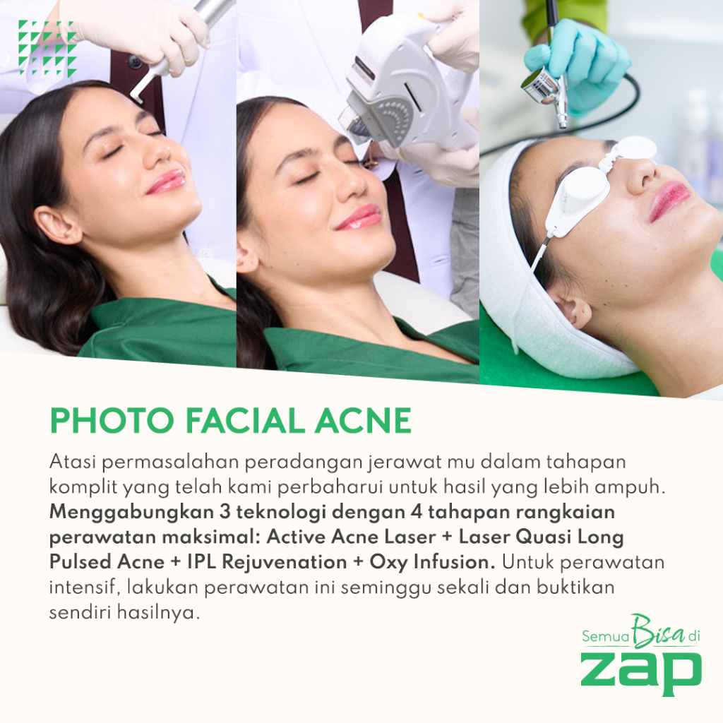 Basic Photo Facial Acne - Active Acne Laser + Laser Quasi Long Pulsed Acne + IPL Rejuvenation (125 shots) + Oxy Infusions